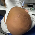 Une femme réclame l'interdiction du "BBL liquide" suite à opération ratée : fesses trouées et qui fuient. (Photos)