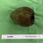 Une noix de coco plantée dans les fesses d'un homme après qu'il l'y ait mise lors d'un acte sexuel