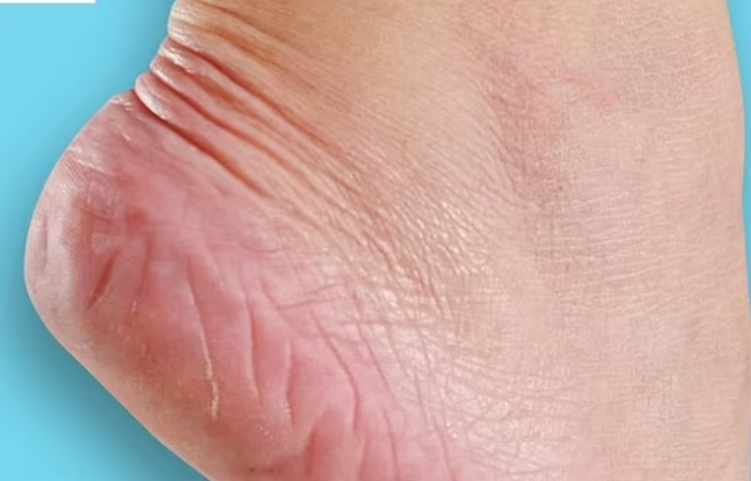 Les acheteurs « embarrassés » ne jurent que par cette crème pour les pieds à petit prix pour réparer rapidement les talons secs et crevassés : « C'est comme de la magie !