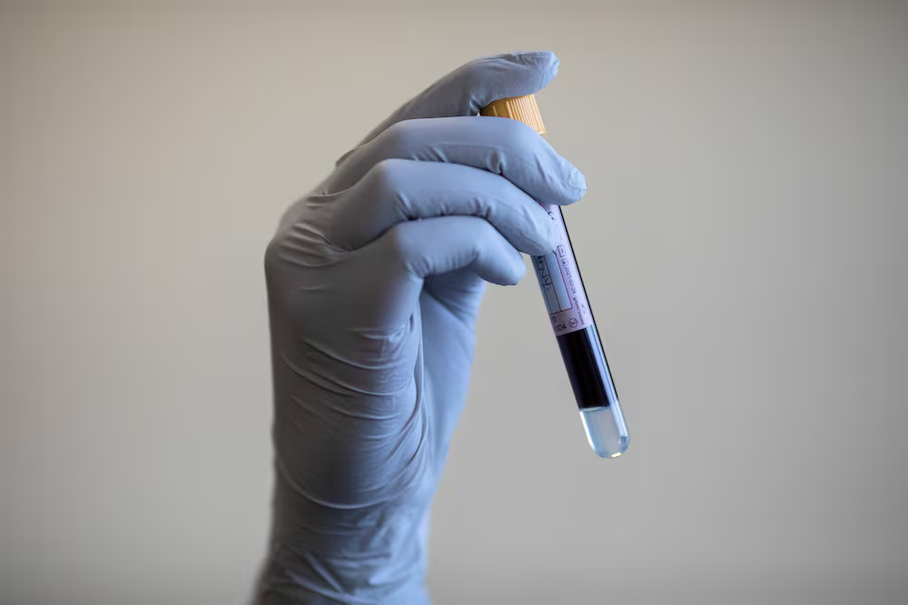 Un test sanguin permet de détecter un cancer sept ans avant qu'il ne se développe