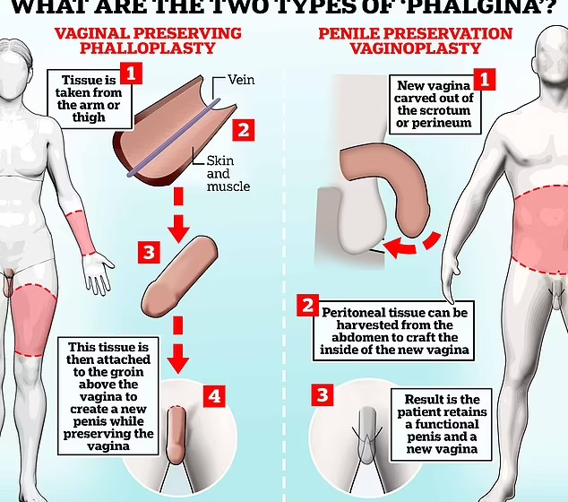  EXCLUSIF:Intérieur de l’étrange ascension de la « phalgina » : Des cliniques cosmétiques proposent des opérations « grotesques » à 10 000 £ pour donner aux personnes non binaires un pénis ET un vagin.