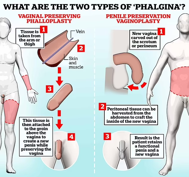 EXCLUSIF:Intérieur de l'étrange ascension de la "phalgina" : Des cliniques cosmétiques proposent des opérations "grotesques" à 10 000 £ pour donner aux personnes non binaires un pénis ET un vagin.