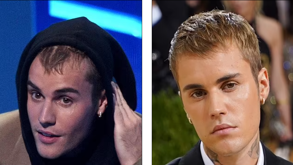 Est-ce la preuve que Justin Bieber a subi une greffe de cheveux ? Un chirurgien de renom révèle les signes révélateurs d'une telle opération.