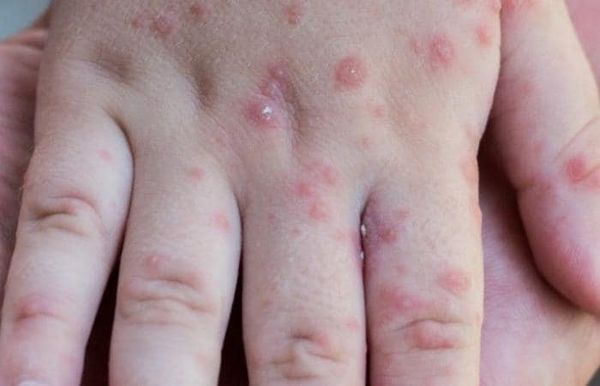 Premier cas de variole du singe signalé en Afrique du Sud