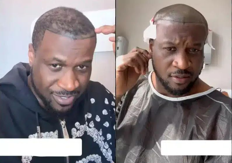  Peter Okoye se fait greffer des cheveux pour cause de calvitie