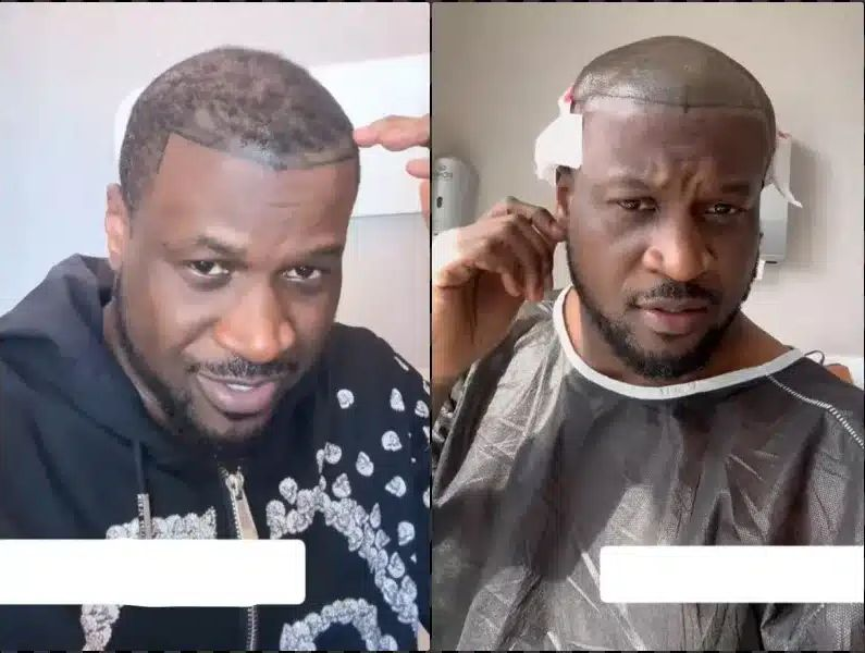 Peter Okoye se fait greffer des cheveux pour cause de calvitie