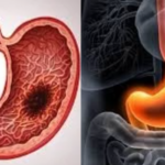 Quels sont les premiers symptômes du cancer de l'estomac