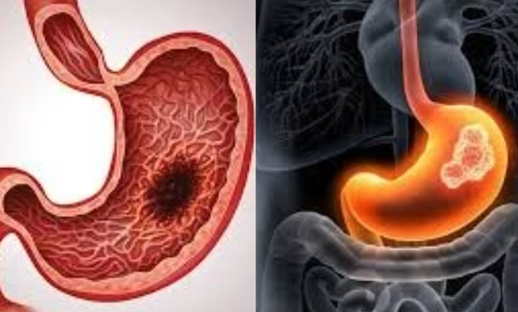  Quels sont les premiers symptômes du cancer de l’estomac