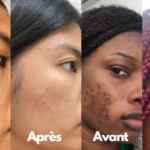 Sérum Anti-Taches Vinoperfect de Caudalie : Avant/Après et Efficacité