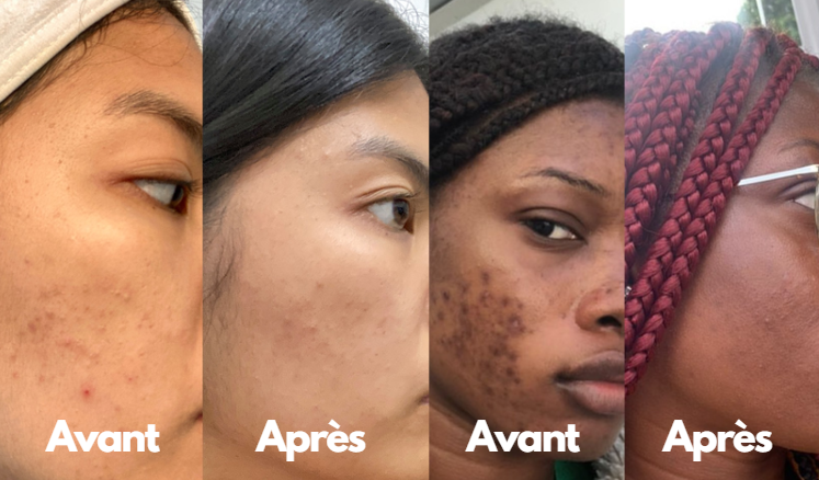  Sérum Anti-Taches Vinoperfect de Caudalie : Avant/Après et Efficacité