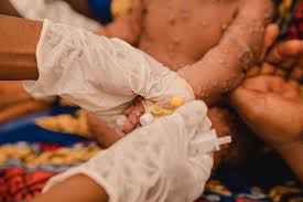  Au Burundi, l’épidémie de Mpox chez les enfants s’aggrave de manière préoccupante.