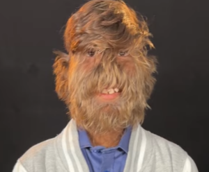 Un adolescent indien atteint du "syndrome du loup-garou" entre dans le Guinness World Records